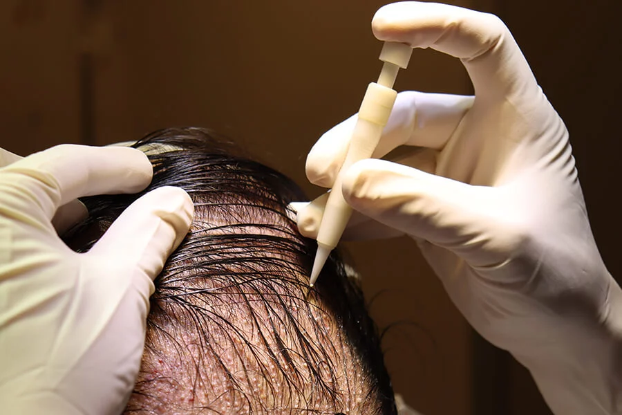 5 Vorteile der DHI-Methode bei der Haartransplantation