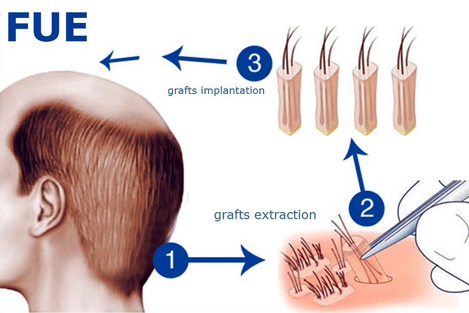 6000 Grafts Transplantieren Lassen: Ist es Möglich?