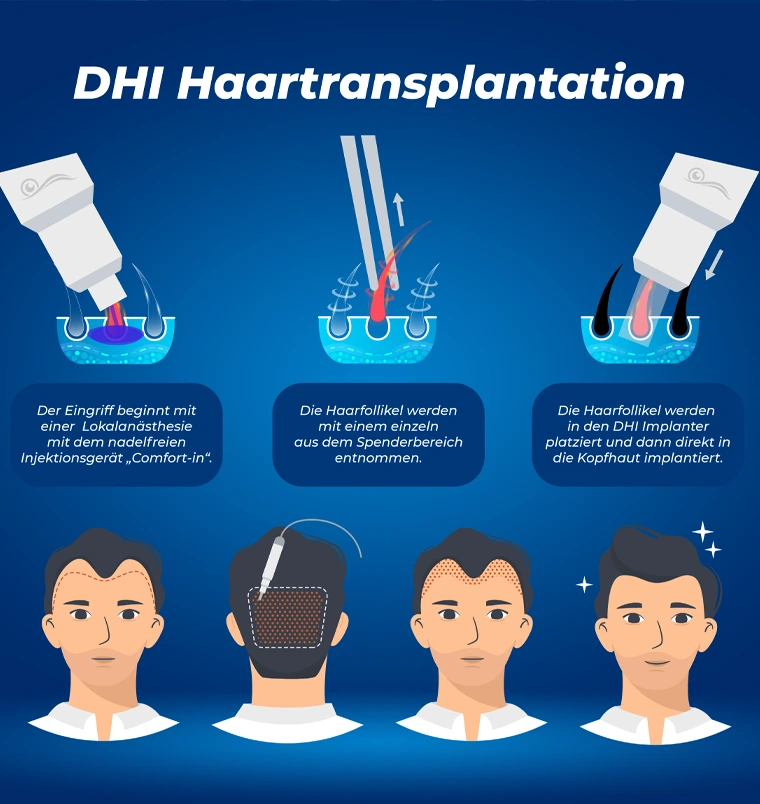 DHI-Haartransplantation Türkei / Antalya