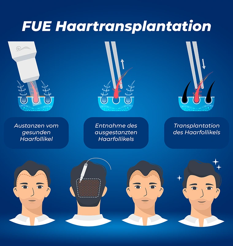 FUE-Haartransplantation Türkei Antalya
