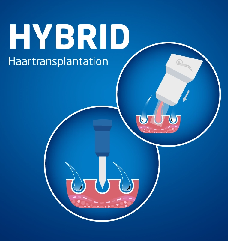 Hybrid Haartransplantation Türkei