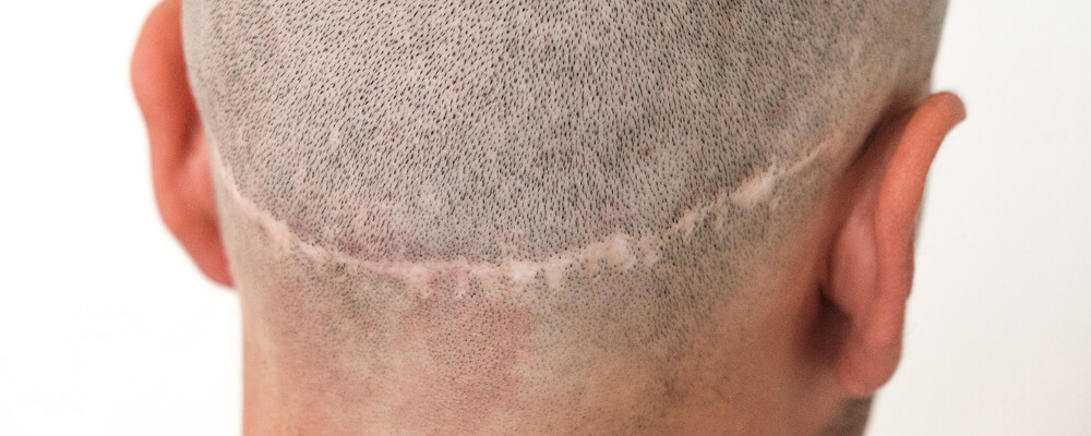 wurde erstmals vom Dermatologen Dr. Robert M. Bernstein in seiner Publikation “Follicular Hair Transplantation – FUT” vo